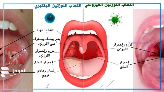 ما الفرق بين التهاب الحلق الفيروسي والبكتيري … العلاج ونصائح للوقاية منه