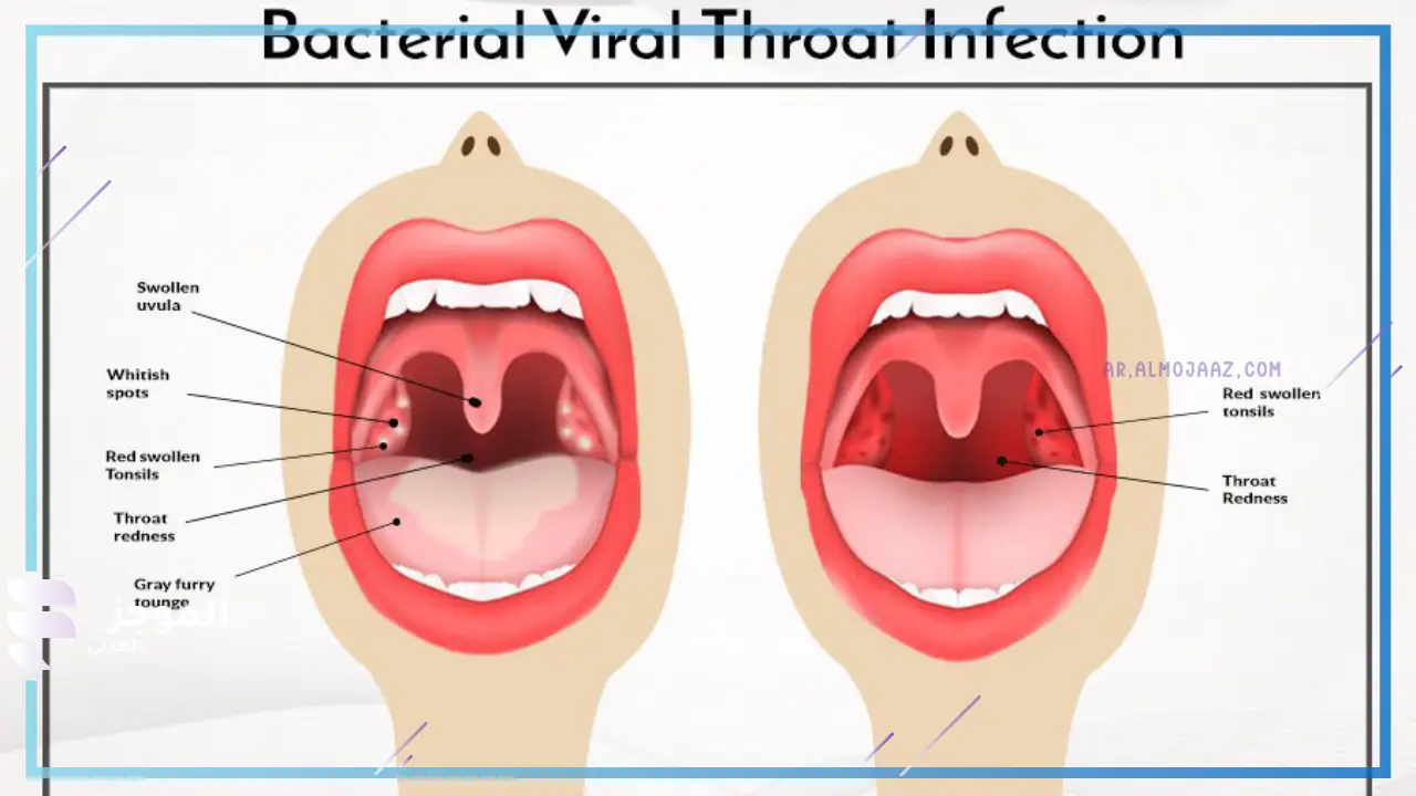 نصائح للوقاية من الإصابة بالتهاب الحلق الفيروسي والبكتيري