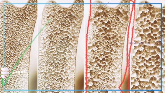 المضاعفات الخطيرة لهشاشة العظام